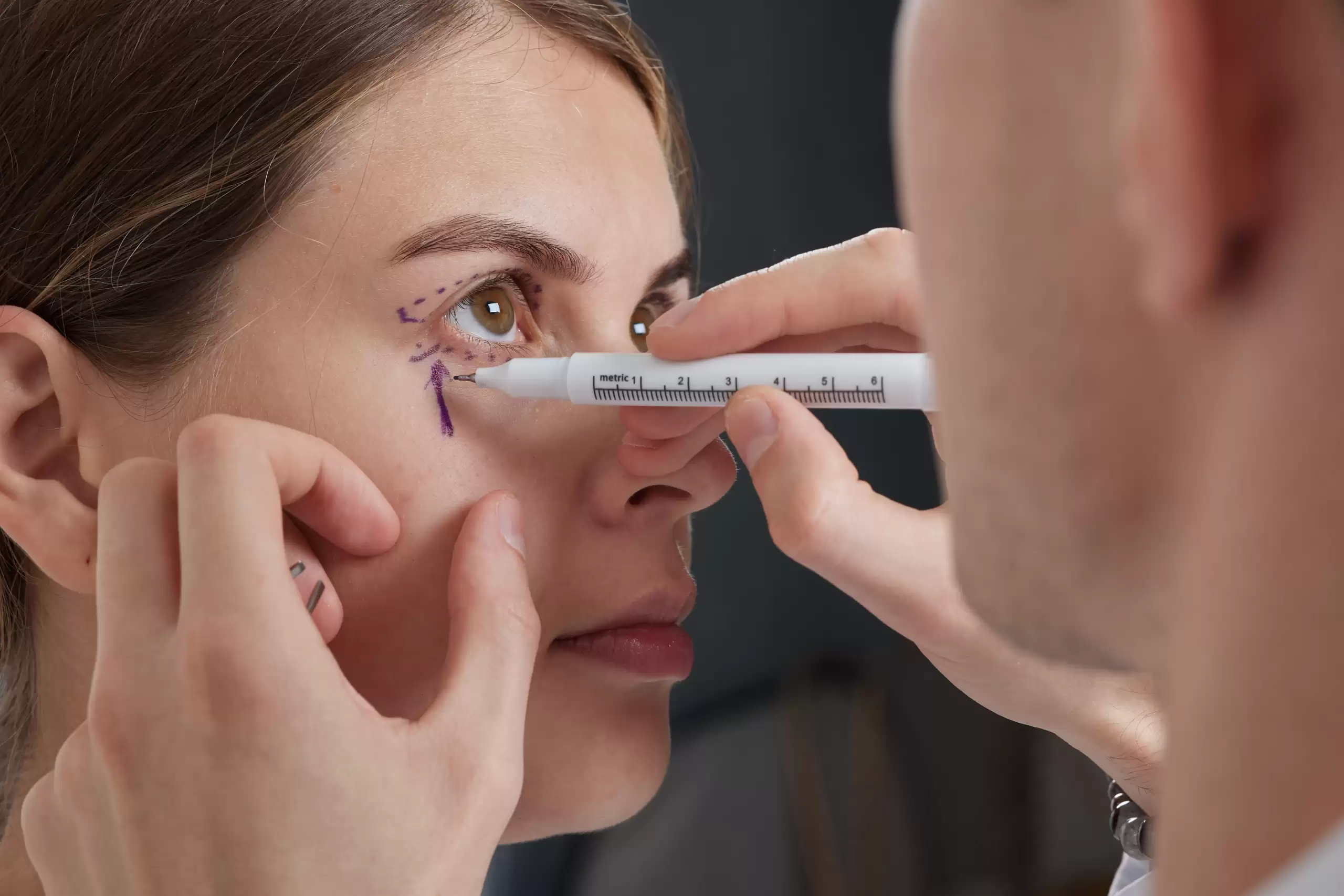 Imagen de una mujer que se someterá a un tratamiento de blefaroplastia par rejuvenecer su mirada.