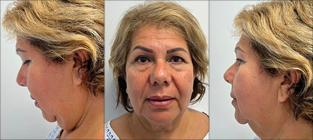 Imagen de comparación de un paciente antes del lifting facial, mostrando las condiciones iniciales de la piel.