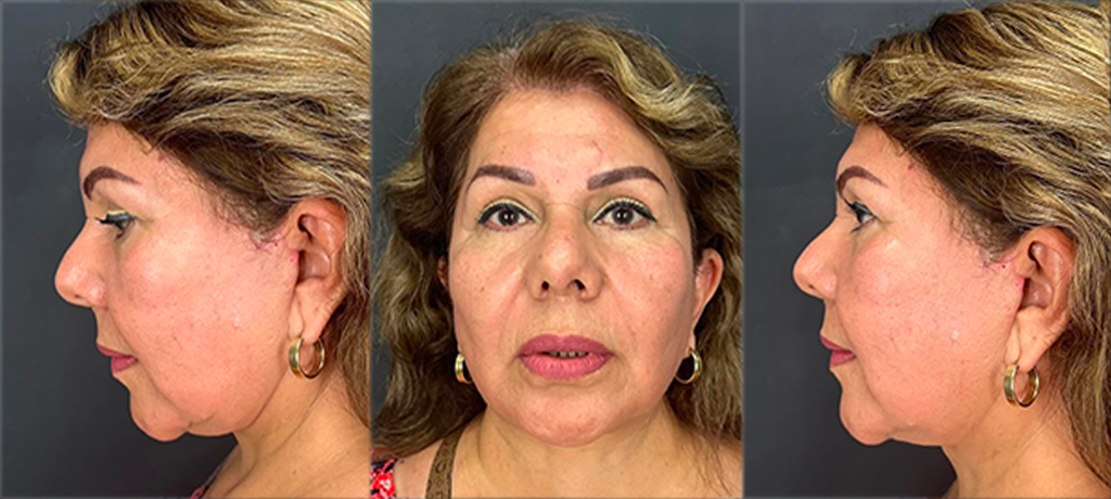 Imagen de comparación de un paciente después del lifting facial, evidenciando la mejoría y firmeza en la piel.