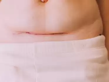 Conoce esta información importante sobre la abdominoplastia: recuperación, cuidados y más
