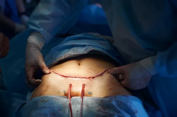 Resultado inicial de la incisión abdominal después de la operación de abdomen Herida cerrada con sutura tras cirugía estética de abdominoplastia recuperación