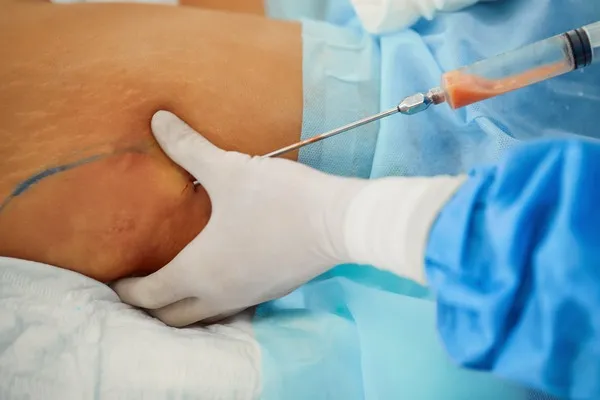 Médico realizando liposucción quirúrgica, parte fundamental para entender la diferencia entre liposucción y lipoescultura. Extracción de grasa durante liposucción, un procedimiento enfocado en eliminar volumen, a diferencia de la lipoescultura.
