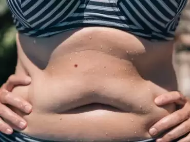 ¿Cuál es la diferencia entre abdominoplastia y lipoescultura? ¿Cómo saber cuál me conviene?