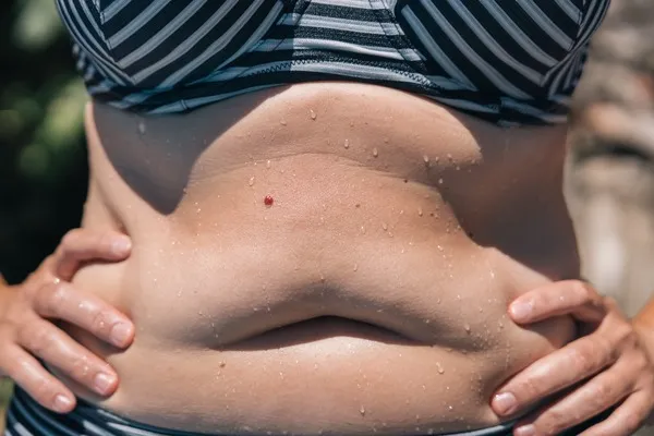 ¿Cuál es la diferencia entre abdominoplastia y lipoescultura? ¿Cómo saber cuál me conviene?