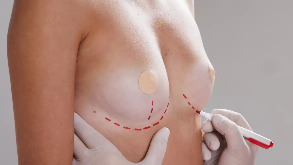 Cirugía de busto: según tipo de cuerpo, ¿cuál me conviene?
