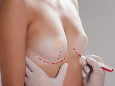 Cirugía de busto: según tipo de cuerpo, ¿cuál me conviene?