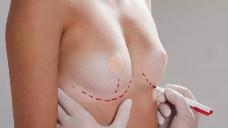 Cirugía de busto: según tipo de cuerpo, ¿cuál me conviene?