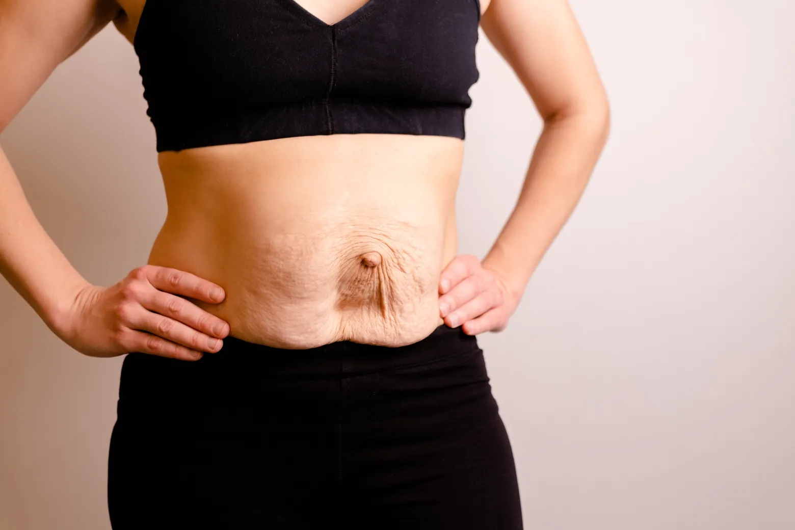 Fotografía del abdomen con piel flácida y sin firmeza de una paciente antes de someterse a un procedimiento mommy makeover