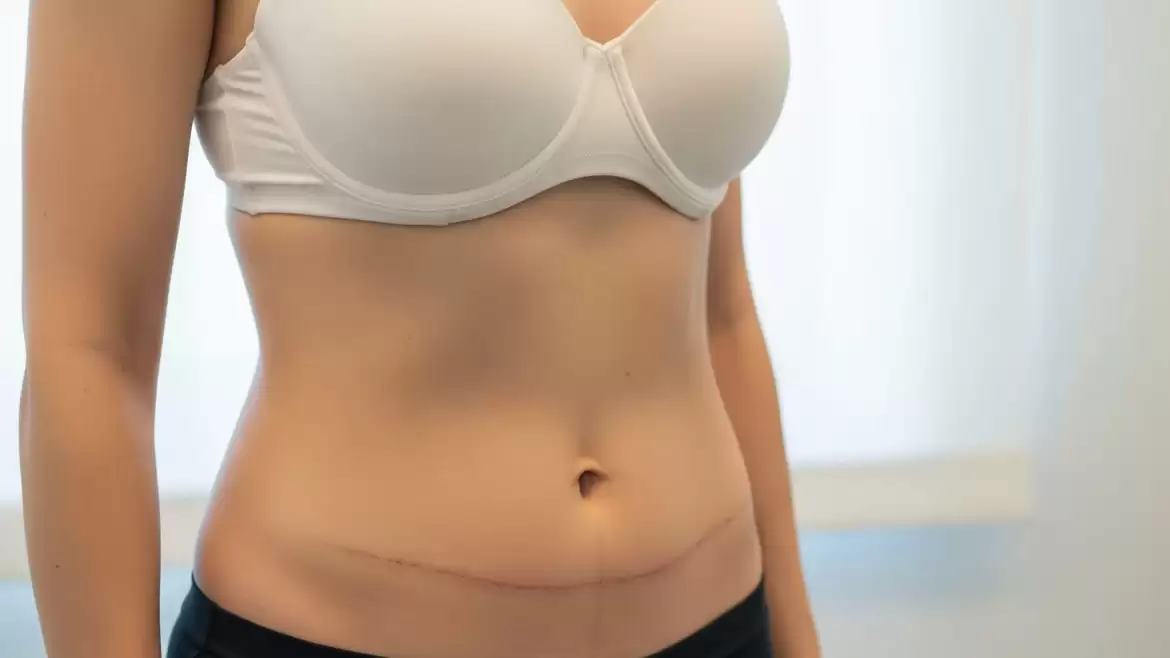 ¿Cómo es el procedimiento Mommy Makeover completo?