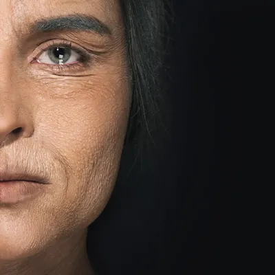 Primer plano de una mujer con signos de envejecimiento en la piel mostrando arrugas profundas como ejemplo del antes de un lifting facial