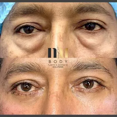 Beneficios de la cirugía de párpados en Monterrey