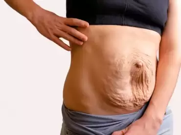 ¿Qué es la lipectomía abdominal?: el procedimiento para tener el cuerpo que has soñado