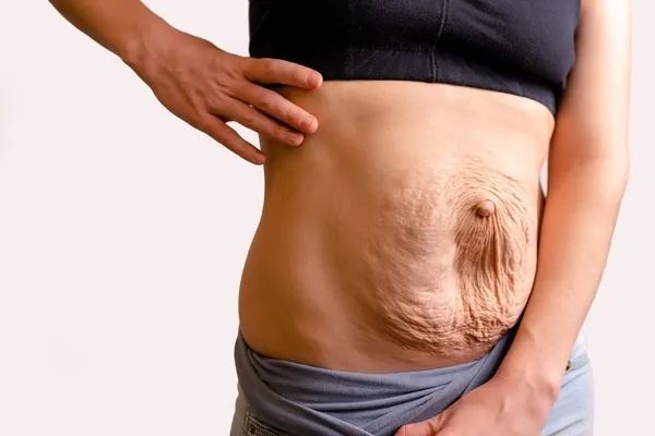 ¿Qué es la lipectomía abdominal?: el procedimiento para tener el cuerpo que has soñado