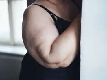¿Cuándo es buena idea realizarse un lifting de brazos?