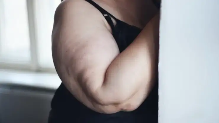 ¿Cuándo es buena idea realizarse un lifting de brazos?