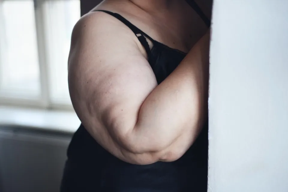Braquioplastia para corregir flacidez cutánea