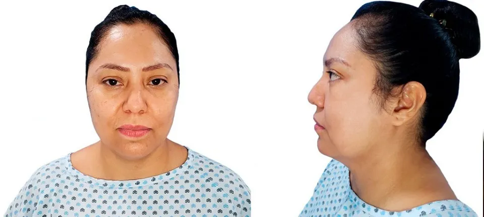 Una mujer de mediana edad se muestra de frente y de perfil, con un bulto visible debajo de la barbilla y en el cuello antes del tratamiento de liposucción.