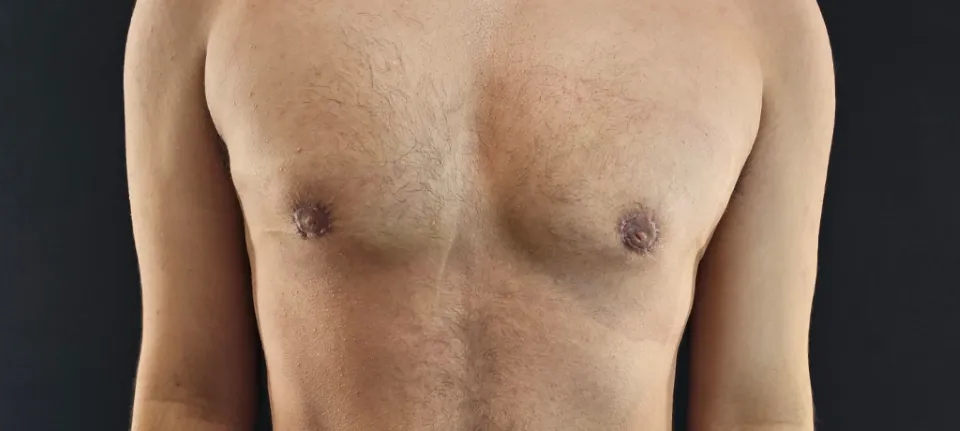 Una toma de primer plano del torso de un hombre trans que muestra los resultados de su masculinización FTM de tórax.