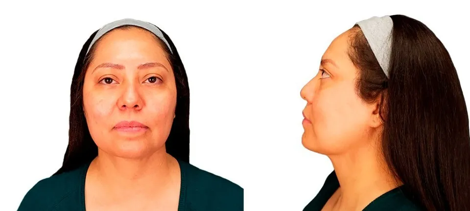 Mujer de mediana edad en la misma pose que antes de la operación, mostrando un cuello más delgado y un contorno de mandíbula mejorado tras la lipo.
