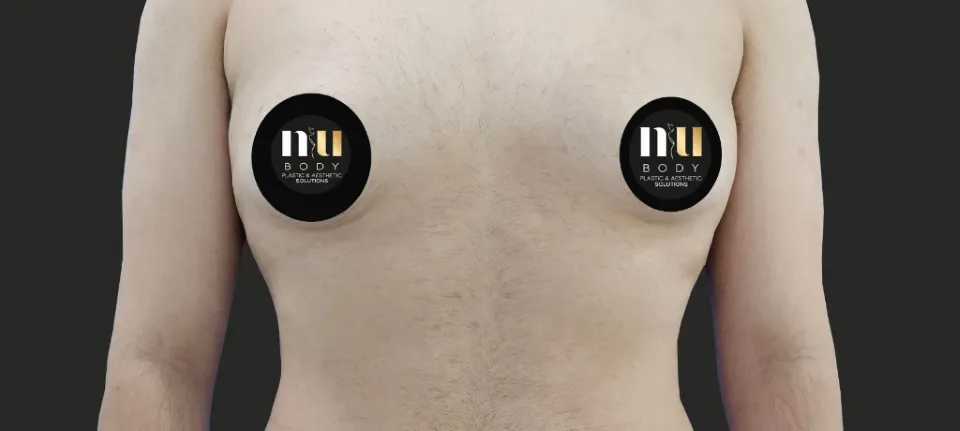 Primer plano del torso de un hombre trans antes del procedimiento, mostrando la forma del tórax.