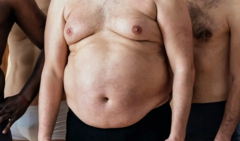 Primer plano del torso de un hombre con sobrepeso que muestra senos masculinos prominentes, un signo de ginecomastia.