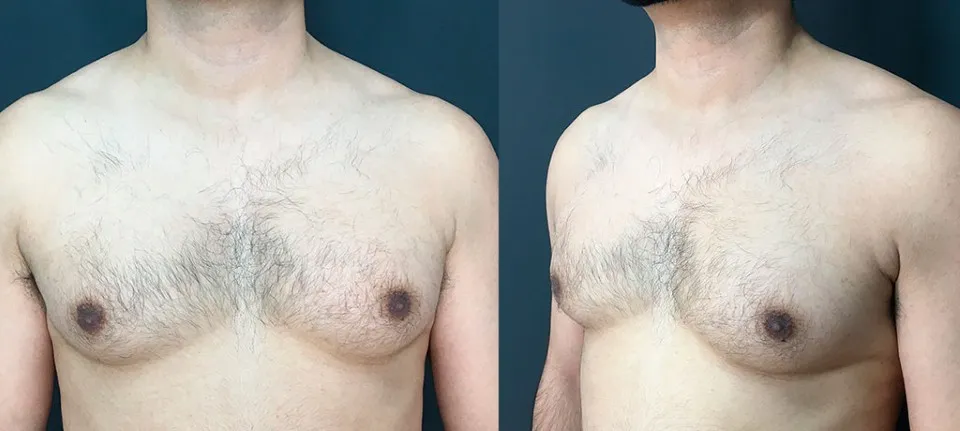 Vistas frontal y lateral del torso de un hombre con moretones amarillos después de una cirugía de reducción de ginecomastia.