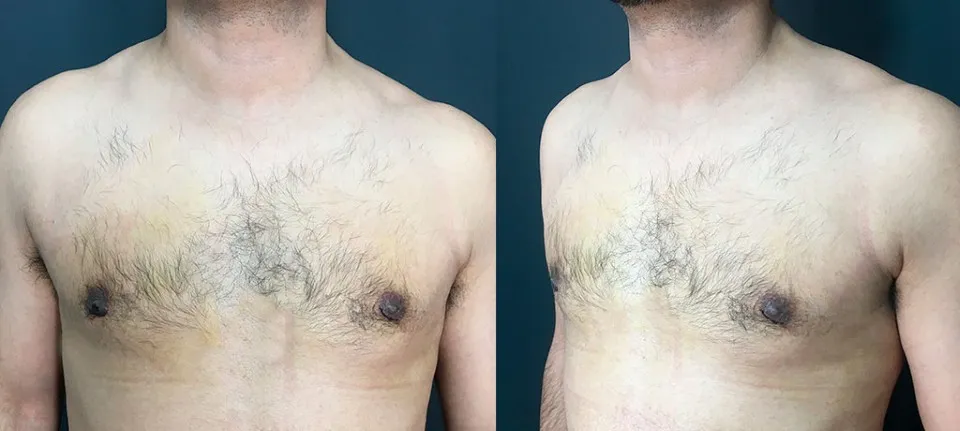 Torso masculino con vello en el pecho, mostrando el contorno de los senos antes de un posible tratamiento de ginecomastia.