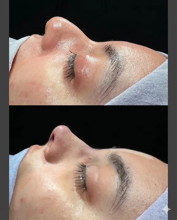 Antes y después de una rinoplastia: perfil lateral que muestra la corrección de una giba nasal y la punta de la nariz elevada.