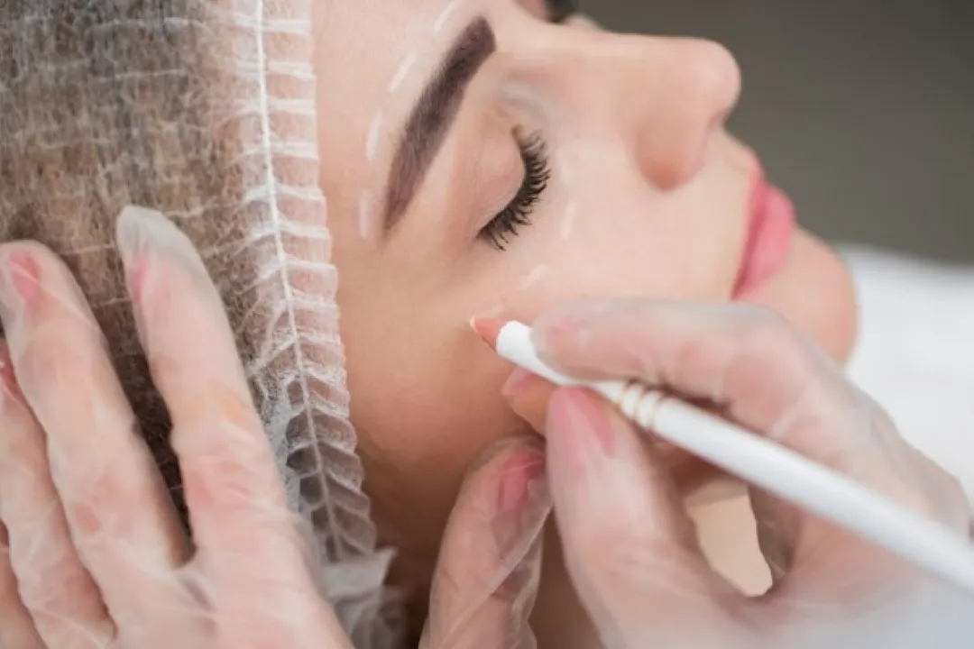 Preparación facial para cirugía plástica con marcaciones preoperatorias.