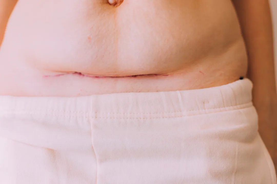 Detalle de la línea de incisión sanando en el vientre bajo, un resultado común después de un mommy makeover de abdomen. Primer plano de una cicatriz quirúrgica horizontal en el bajo abdomen tras una cirugía de mommy makeover.
